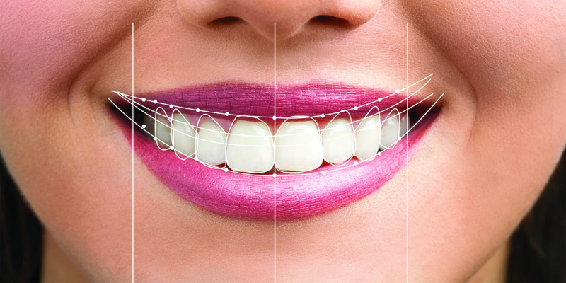 Smile Designing Treatment
